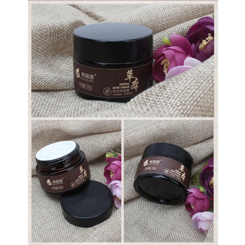 Facial Face Cream  Anti-Pimple Acne Herbal  Whitening Cream