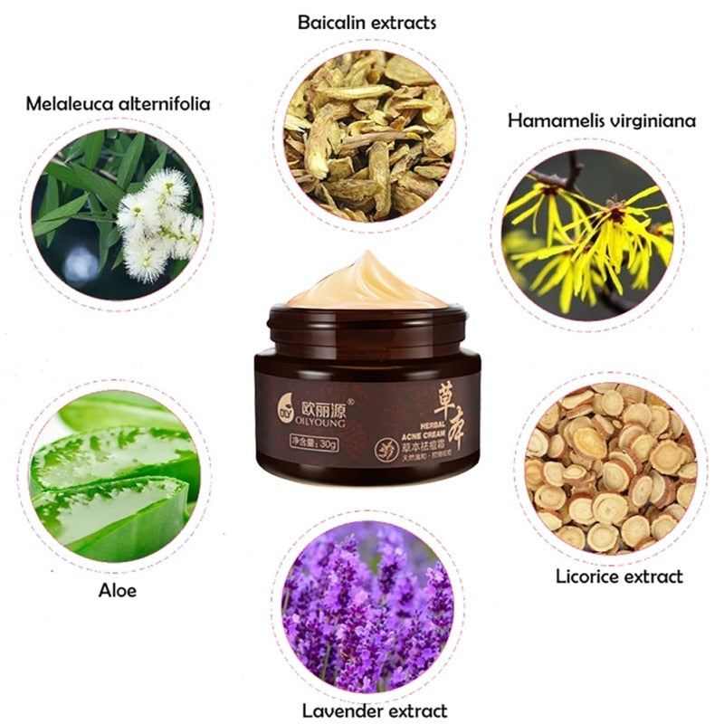 Facial Face Cream  Anti-Pimple Acne Herbal  Whitening Cream