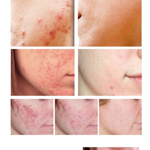 Acne Removal Cream Acne Treatment Fade Acne Spots Skin Care