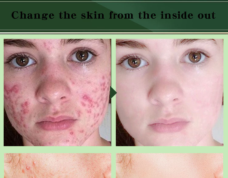 Acne Removal Cream Acne Treatment Fade Acne Spots Skin Care