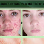 Acne Removal Cream Acne Treatment Fade Acne Spots Skin Care