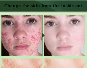 Acne Removal Cream Acne Treatment Fade Acne Spots Skin Care