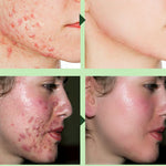 Acne Removal Cream Acne Treatment Fade Acne Spots Skin Care