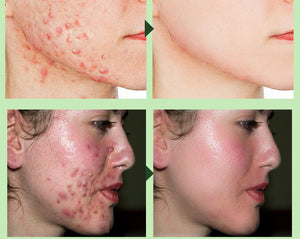 Acne Removal Cream Acne Treatment Fade Acne Spots Skin Care