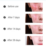 Acne Removal Cream Acne Treatment Fade Acne Spots Skin Care