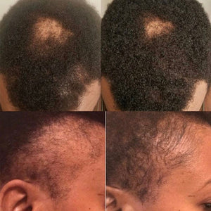 Fast Hair Growth Serum Natural Hair Loss Treatment  for Thinning Hair