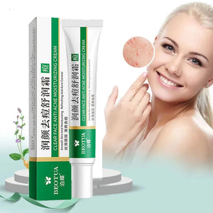 Acne Removal Cream Acne Treatment Fade Acne Spots Skin Care