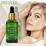 BREYLEE Tea Tree Acne Treatment Face Serum  Moisturizer