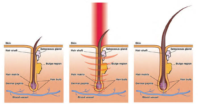 Laser Treatment Cap Stop Hair Loss For Thinning Hair Of Men