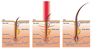 Laser Treatment Cap Stop Hair Loss For Thinning Hair Of Men