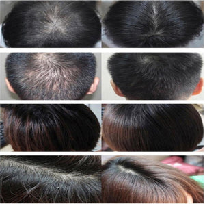 Laser Treatment Cap Stop Hair Loss For Thinning Hair Of Men