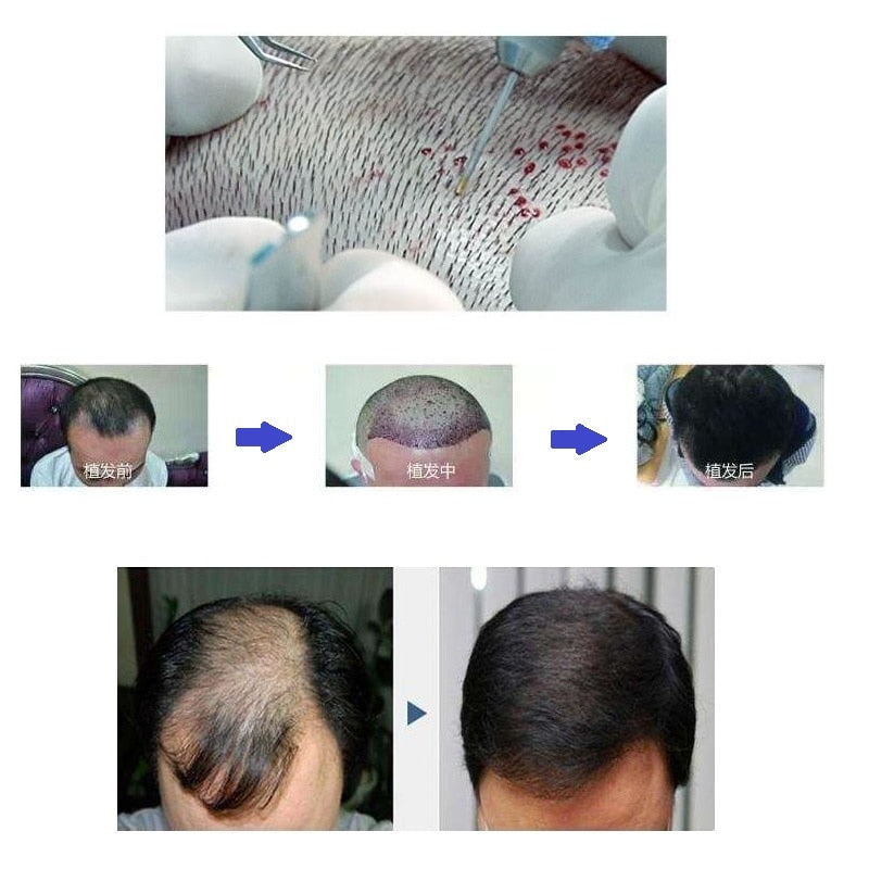 Fue Hair Transplant Hair Follicle Extractor Scarless For Hair Thinning