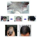 Fue Hair Transplant Hair Follicle Extractor Scarless For Hair Thinning